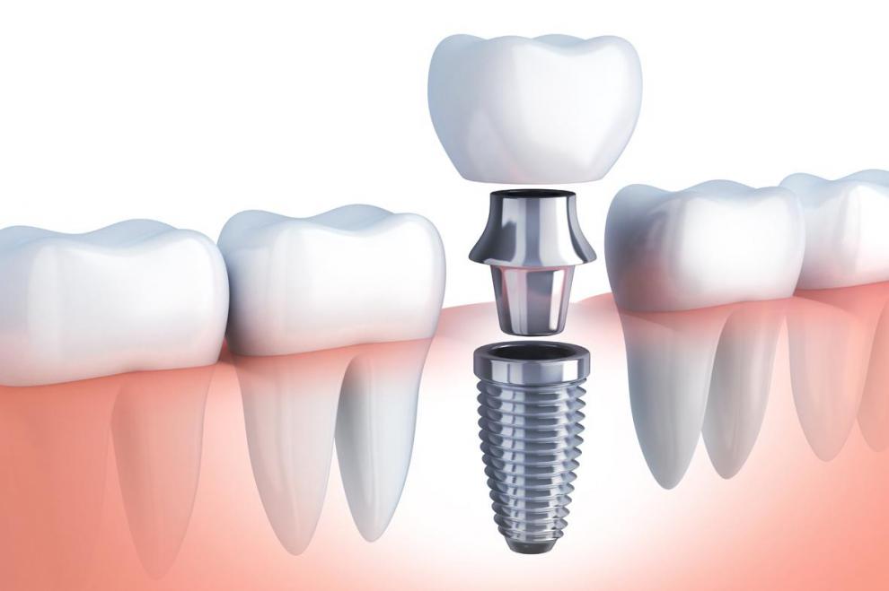 implatologia dental