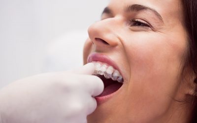 Preguntas frecuentes de la ortodoncia invisible