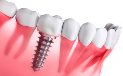 ¿Qué es un implante dental?