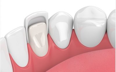Descubre las Carillas de Composite: Mejora tu Sonrisa