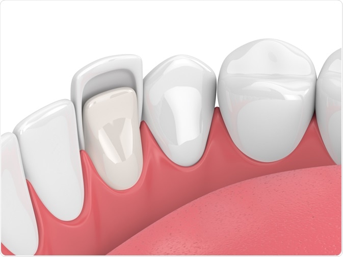 Descubre las Carillas de Composite: Mejora tu Sonrisa