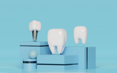 La Durabilidad de los Implantes Dentales