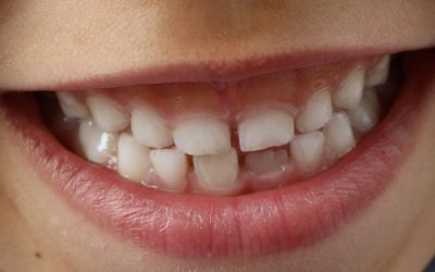 ¿Cómo cuidar la sonrisa de nuestros hijos?